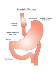 Gastric Bypass