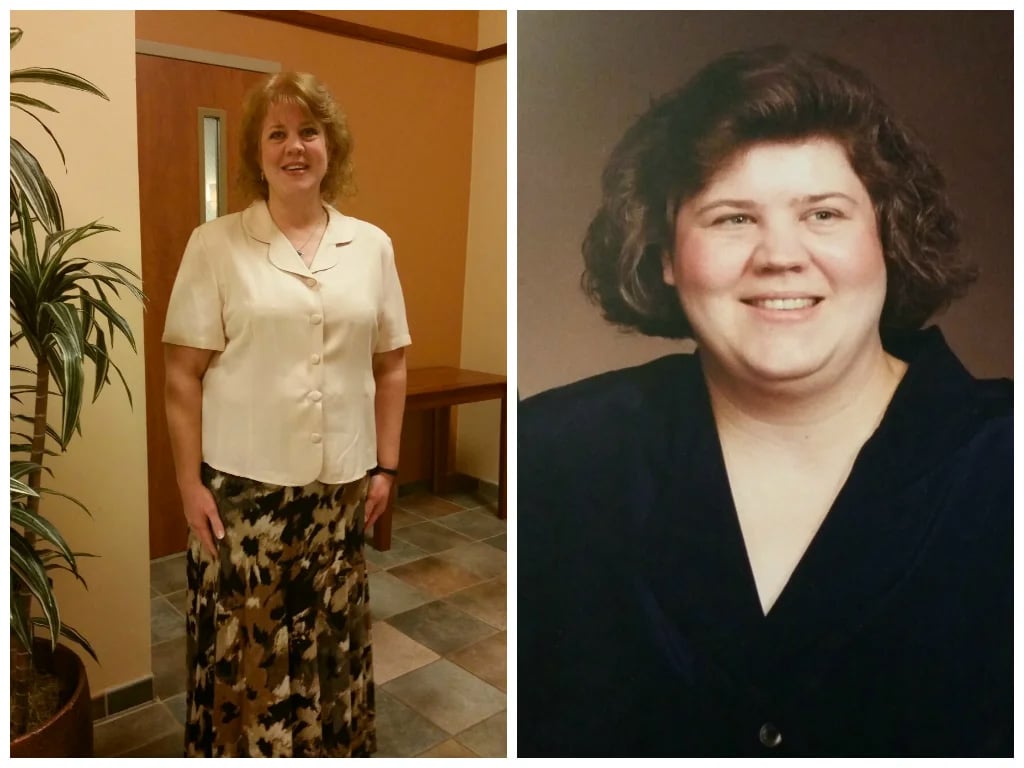 Teresa’s Roux-en-Y Revision Story