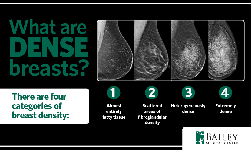 Four levels of breast density: A, almost entirely fatty; B, scattered fibroglandular tissue; C, heterogeneously dense; D, extremely dense.