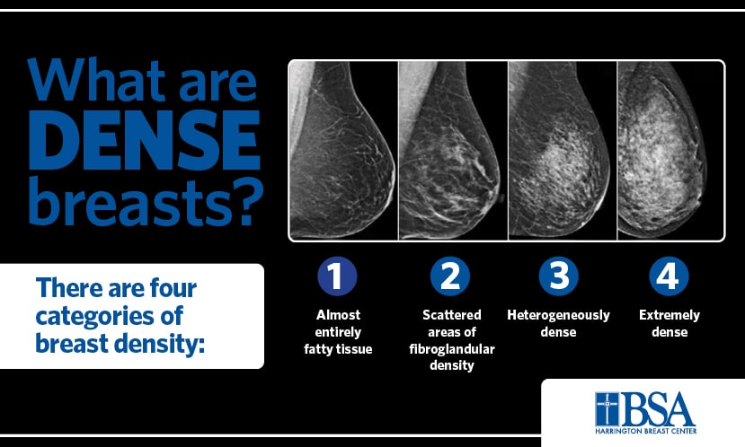 Four levels of breast density: A, almost entirely fatty; B, scattered fibroglandular tissue; C, heterogeneously dense; D, extremely dense.