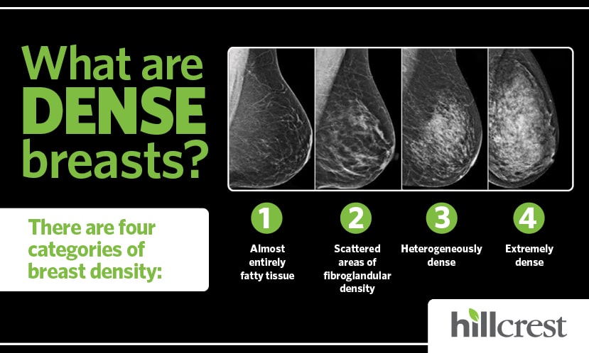 Four levels of breast density: A, almost entirely fatty; B, scattered fibroglandular tissue; C, heterogeneously dense; D, extremely dense.
