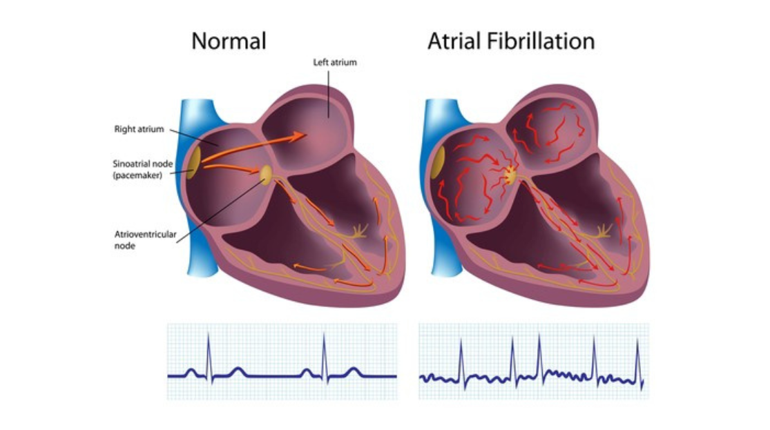 Tens of millions of Americans may have AFIB and not know it