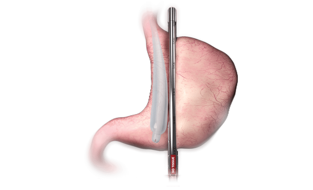 Lovelace Westside Hospital first in New Mexico to perform the sleeve gastrectomy using the Titan SGS™ Stapler