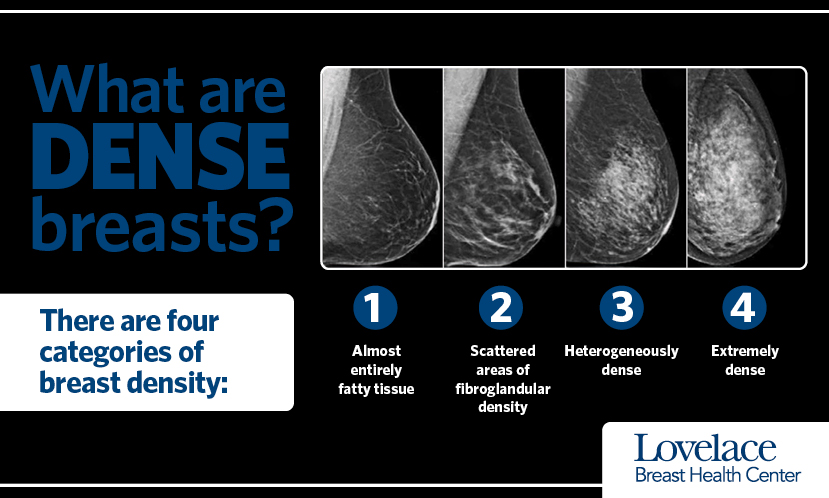 Four levels of breast density: A, almost entirely fatty; B, scattered fibroglandular tissue; C, heterogeneously dense; D, extremely dense.