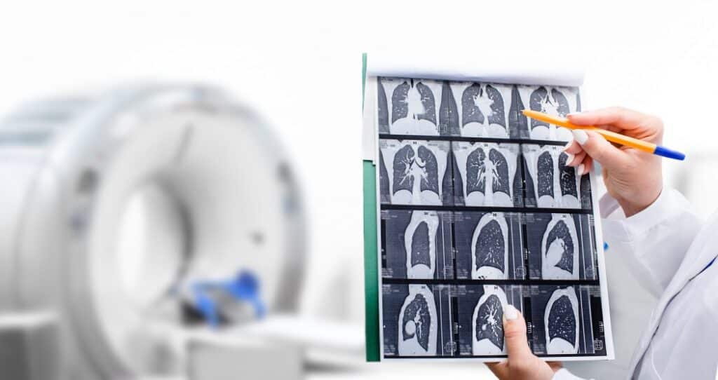 Lung Cancer Screening Saves Lives - Hackensack Meridian Mountainside ...
