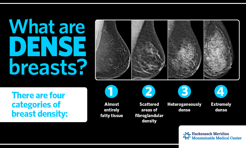 Four levels of breast density: A, almost entirely fatty; B, scattered fibroglandular tissue; C, heterogeneously dense; D, extremely dense.