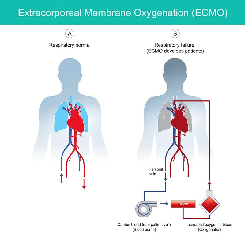 graphic showing how a clot travels from the heart through the body