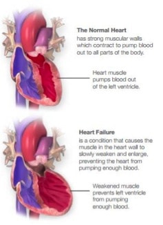 Heart failure comparison graphic
