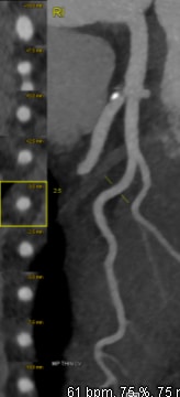vein xray