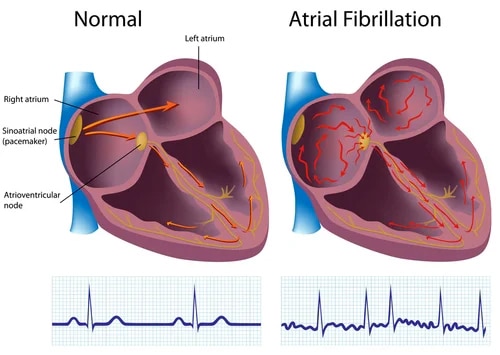 normal versus Atrial Fibrillation graphic