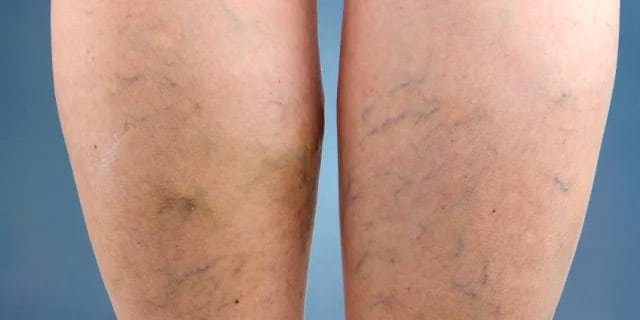 Sclerotherapy and the Treatment of Varicose and Spider Veins