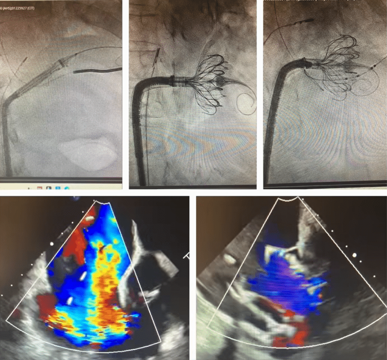 Oklahoma Heart Institute Leads Nation in Groundbreaking Heart Research and First-in-U.S. Device Trial