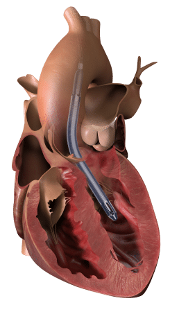 Impella 5.5: Portneuf Medical Center Achieves Another Milestone in Heart Care
