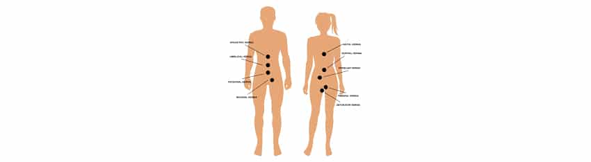 Hernia Awareness Month