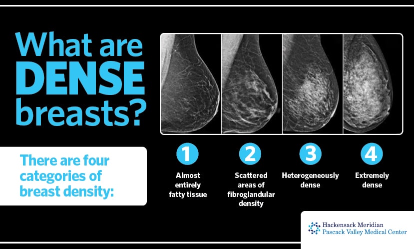 Four levels of breast density: A, almost entirely fatty; B, scattered fibroglandular tissue; C, heterogeneously dense; D, extremely dense.