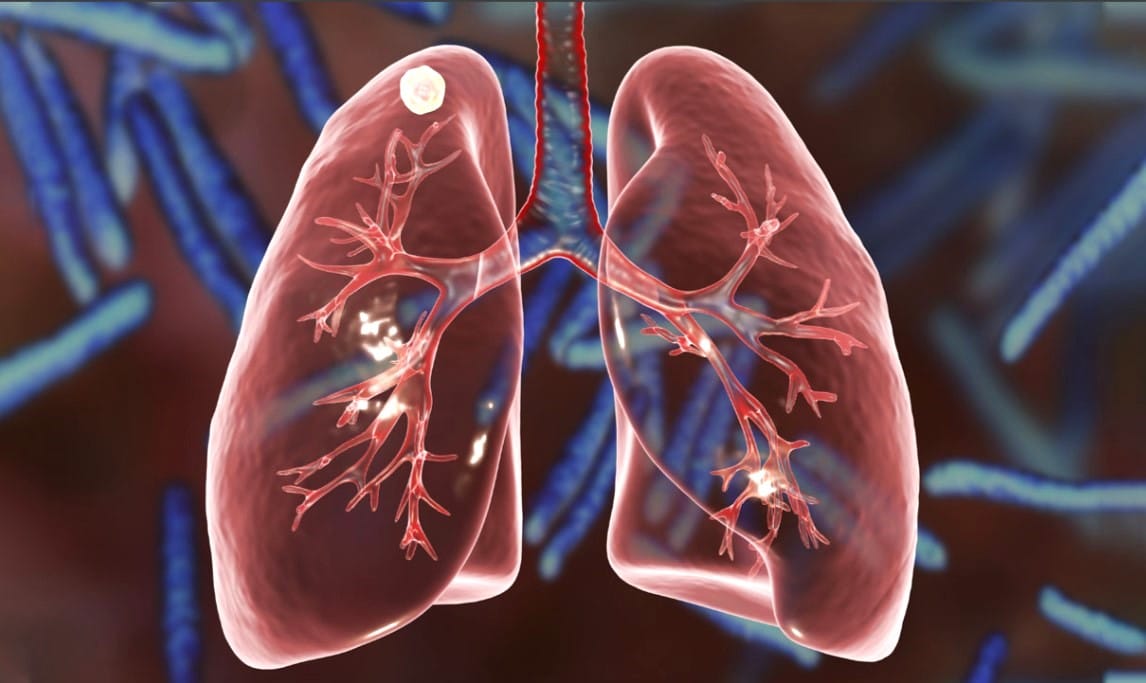 St. Francis Campus first in Topeka to launch advanced AI technology to improve early lung cancer detection and treatment