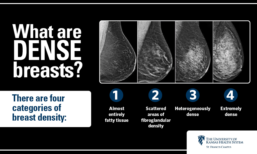 Four levels of breast density: A, almost entirely fatty; B, scattered fibroglandular tissue; C, heterogeneously dense; D, extremely dense.