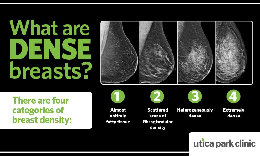 Four levels of breast density: A, almost entirely fatty; B, scattered fibroglandular tissue; C, heterogeneously dense; D, extremely dense.