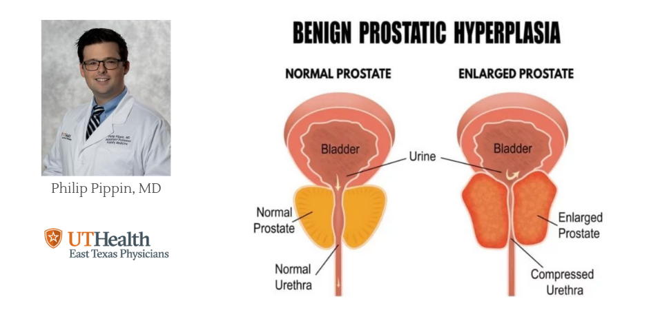 Men’s Health Month: Benign Prostatic Hyperplasia