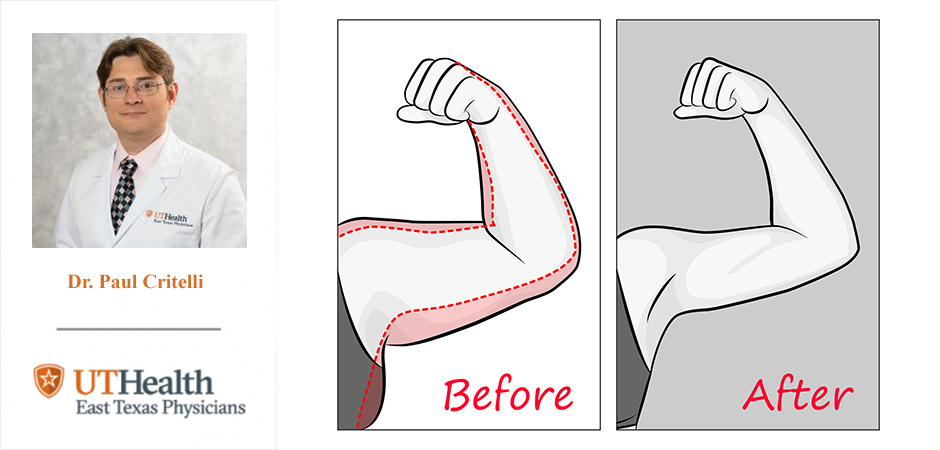 Body Lift to Remove Excess Skin after Weight Loss