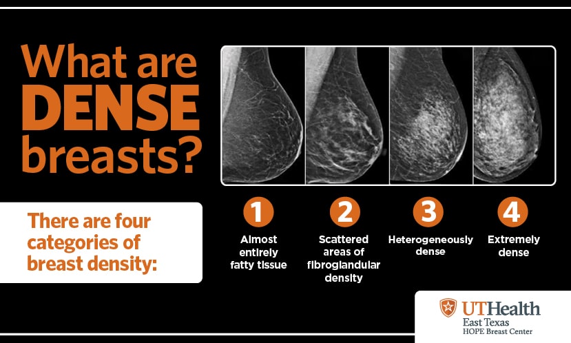 Four levels of breast density: A, almost entirely fatty; B, scattered fibroglandular tissue; C, heterogeneously dense; D, extremely dense.
